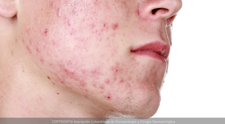 Acné