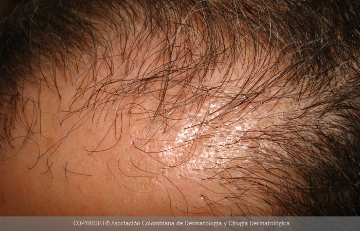 Alopecia andrógena