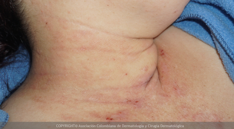 Dermatitis de contacto