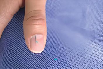 Melanoniquia longitudinal de rápido crecimiento: importancia del seguimiento dermatoscópico y la histopatología