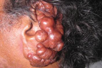 Lobomicosis (Lacaziosis) – serie de casos en Colombia y revisión de la literatura