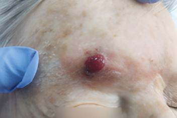 Fibroxantoma atípico: serie de casos