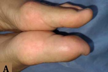 Retroniquia sin paroniquia: un reto diagnóstico