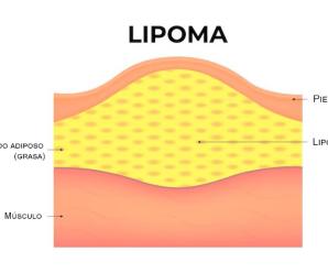 Lipoma